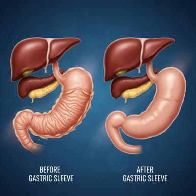 Gastric Sleeve Surgery: Your Comprehensive Guide to Weight Loss Surgery